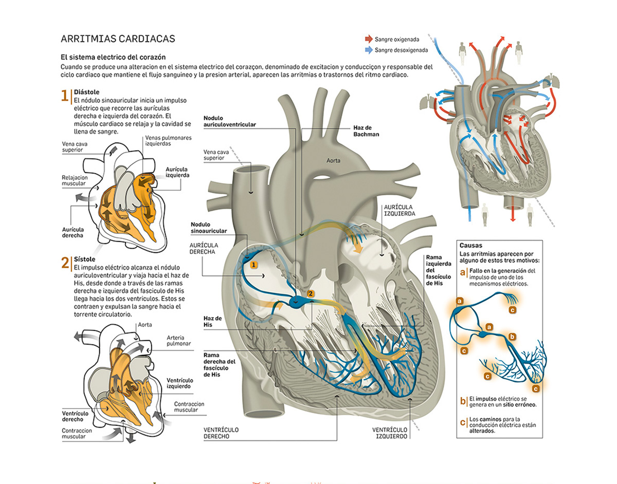 Infografia vectorial sobre arritmias cardiacas