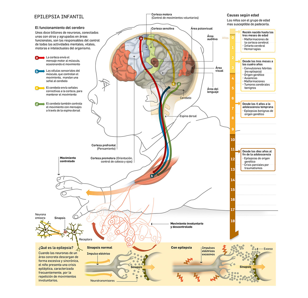 Detalle de infografía sobre epilepsia infantil