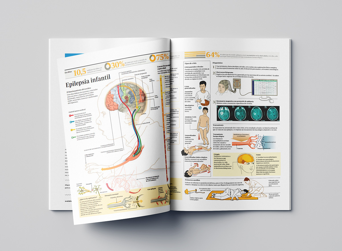 Infografía médica sobre la epilepsia infantil