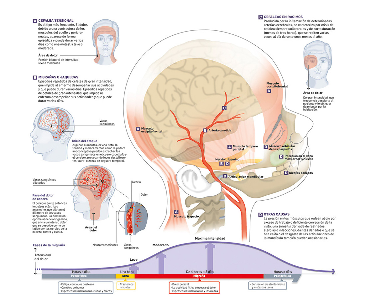 Detalle de ilustración para infografía sobre cefaleas